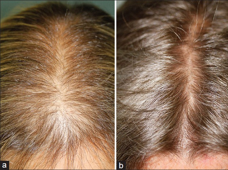 Minoxidil 5% Spray Repousse des cheveux homme Femme, 1 bouteille 60ml + Dermaroller professionnel